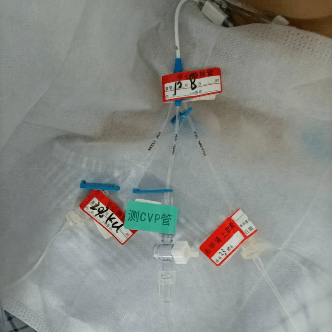 才3天就拔针就是要多收钱cvc置管你了解吗