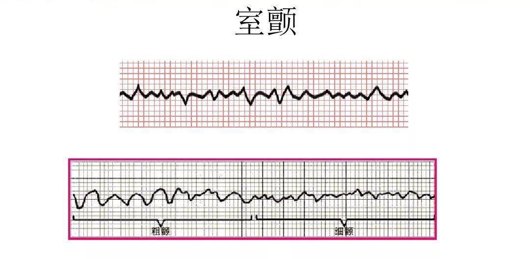 掌握這6項心電圖乾貨波形判斷不再難