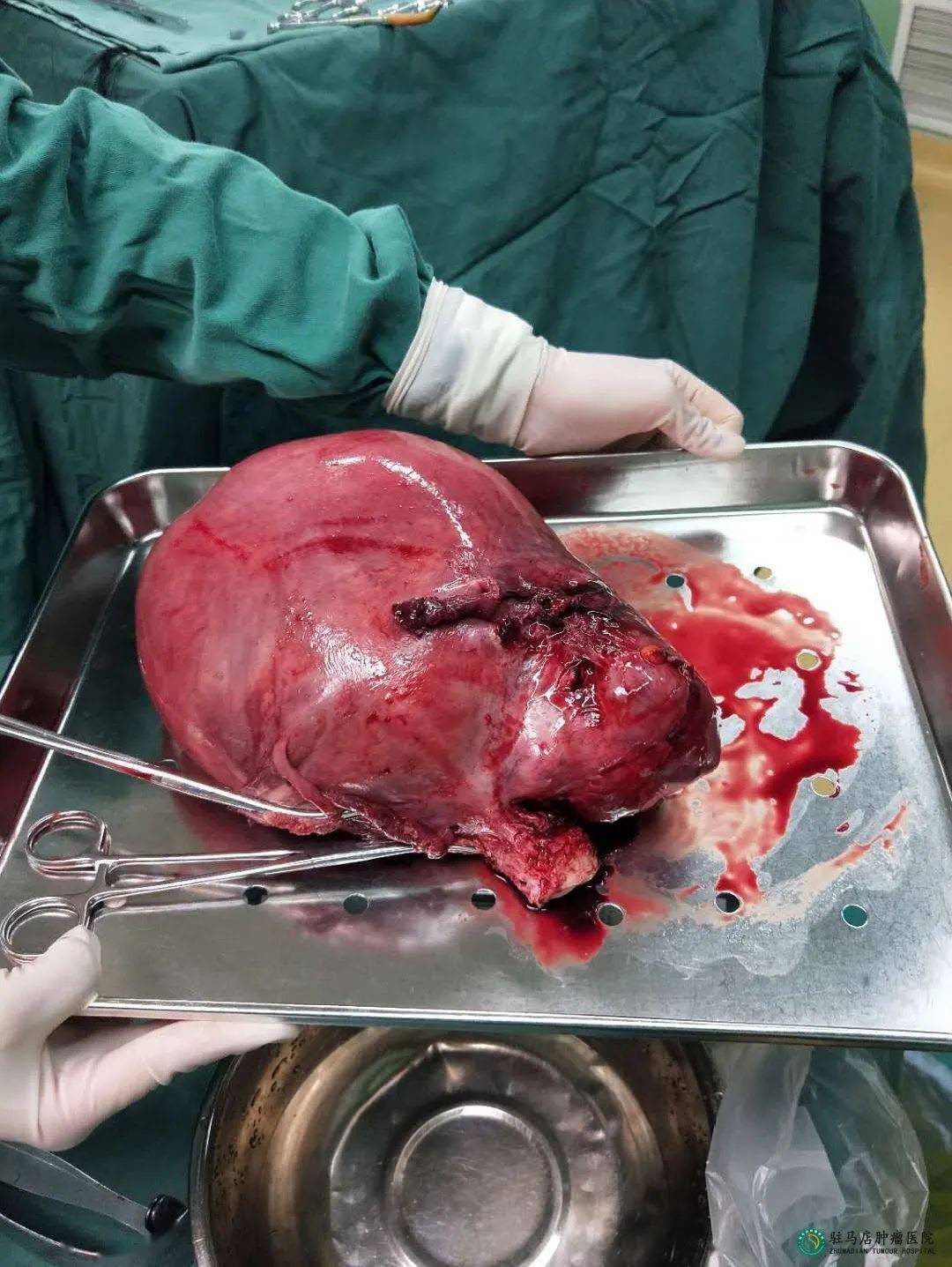 肿瘤医院外科团队完成一例高难度盆腔巨大肿瘤切除术