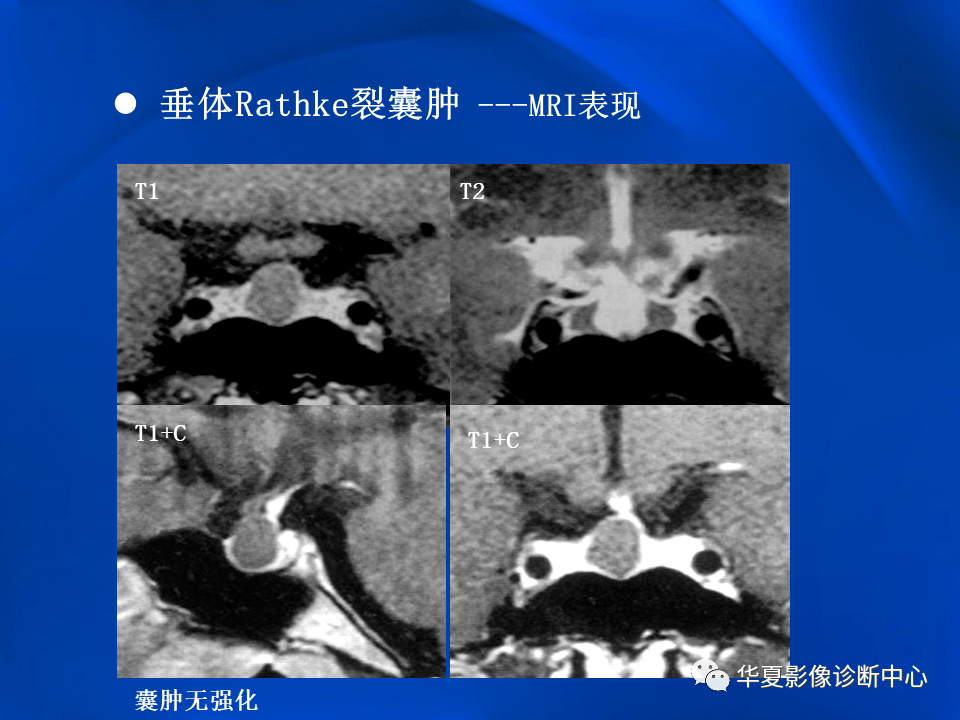 垂体rathke裂囊肿mr表现