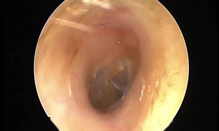 原来人类正常的外耳道皮肤及腺体的分泌物(耵聍,俗称耳屎),对外耳道