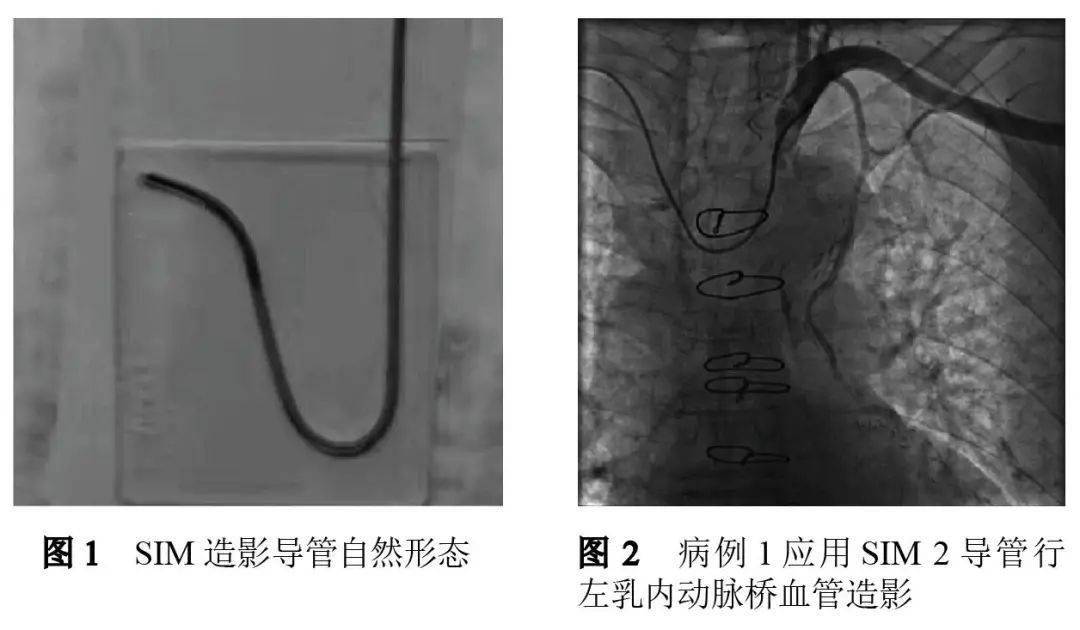 冠状动脉旁路移植术后经右桡动脉入径行左乳内动脉桥血管造影_导管