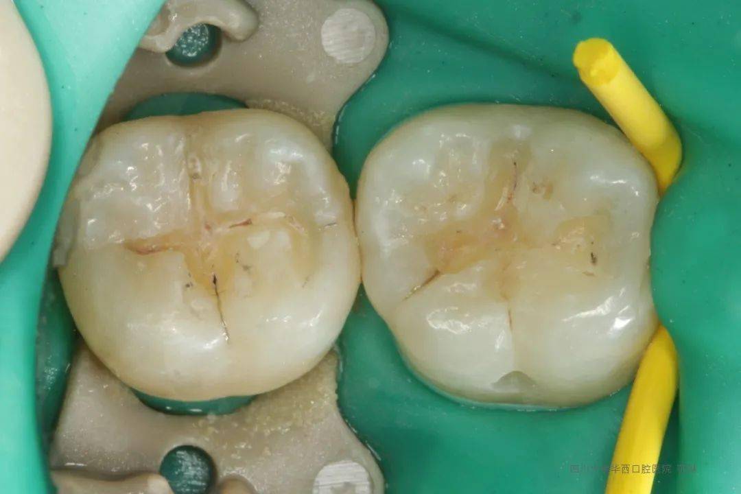 松风病例秀范琳一支百元树脂完成后牙颌面美学视频图片动静结合再现