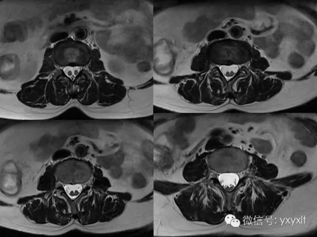帮你梳理脊髓纵裂