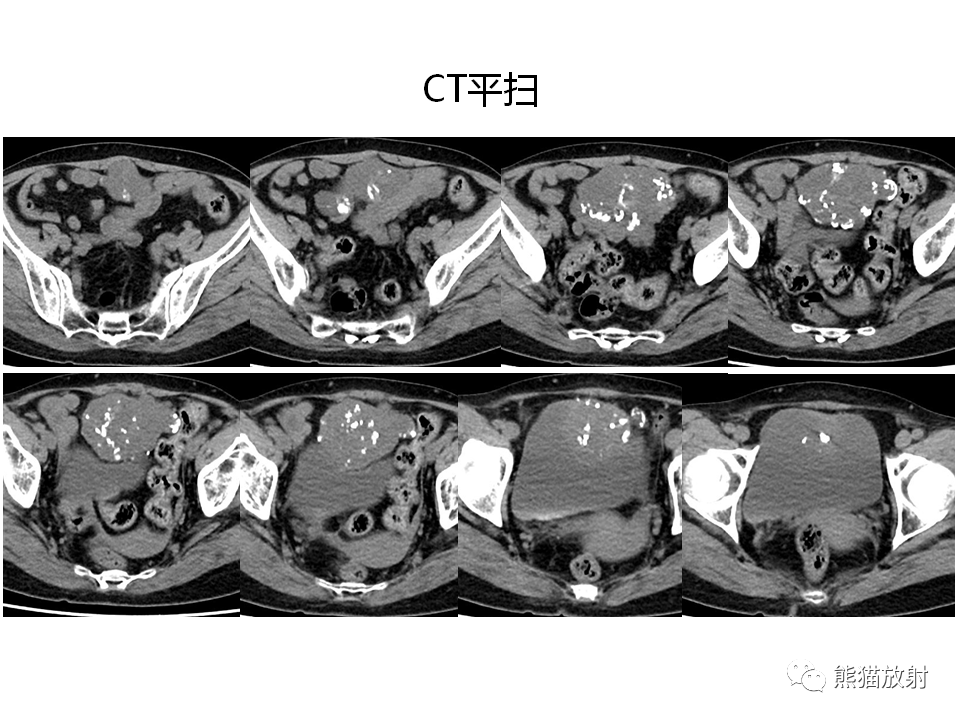 脐尿管脓肿↓ 相关内容链接:【专题】脐尿管畸形与脐尿管癌的ct表现