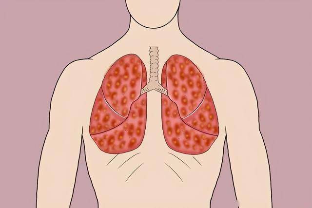 肺癌疼痛点的位置图图片
