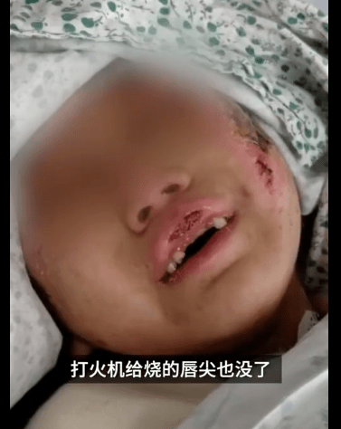 沸水浇头铁钳拔牙烧嘴唇6岁女童被亲妈和男友狂虐3个月外婆报警还收到