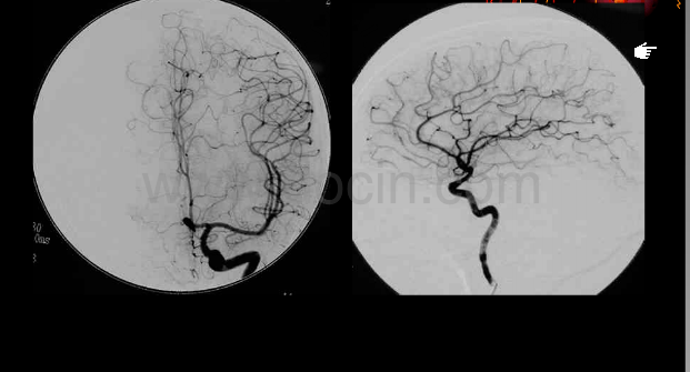 解剖颅内血管丨轻松看懂脑血管造影