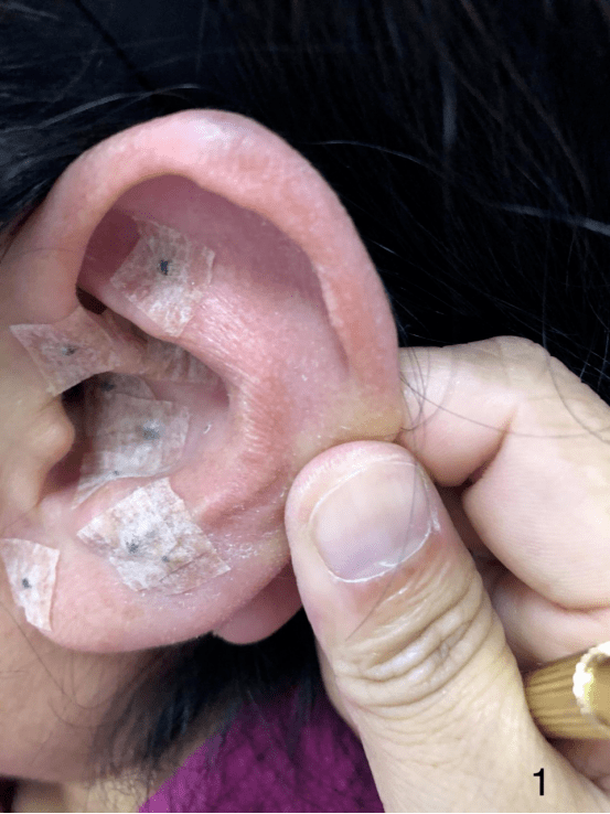 观耳识疾病贴耳促健康
