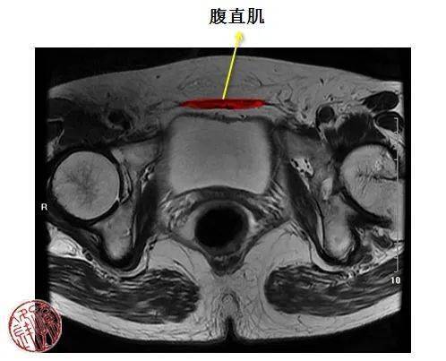 医学笔记一起读盆腔核磁共振经女性股骨头韧带的横断层