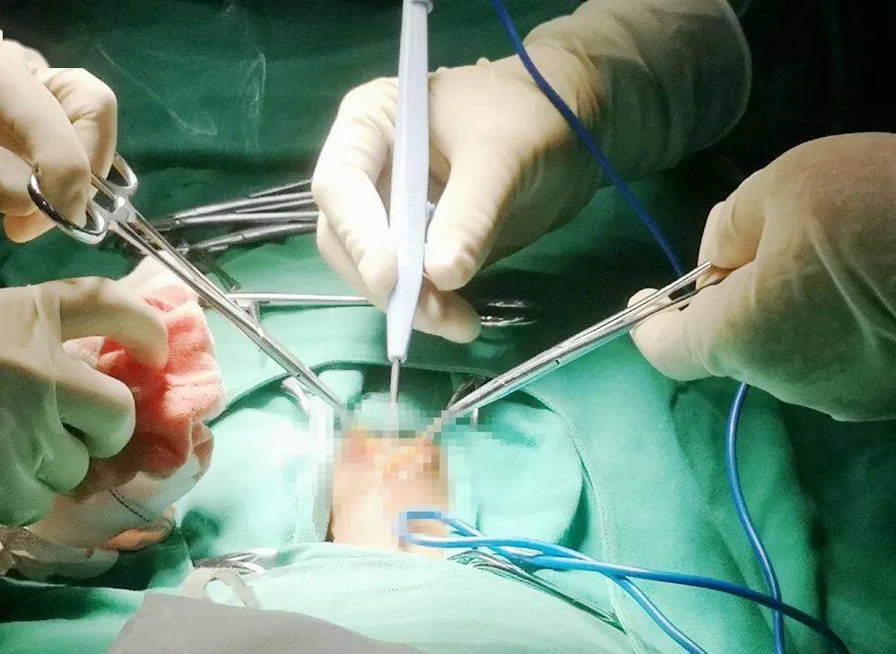 成功实施手术术前培训此例手术的成功开展,填补了西盟县人民医院慢性