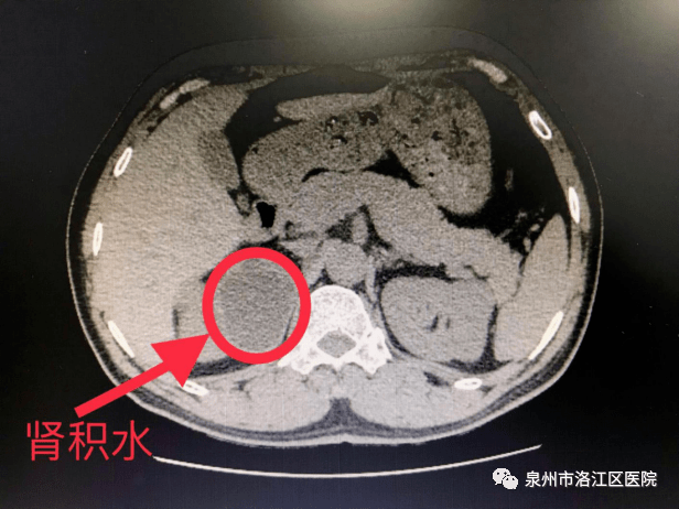 患者蘇某某,男,52歲,10月26日因右側輸尿管結石伴右腎積水入院治療.