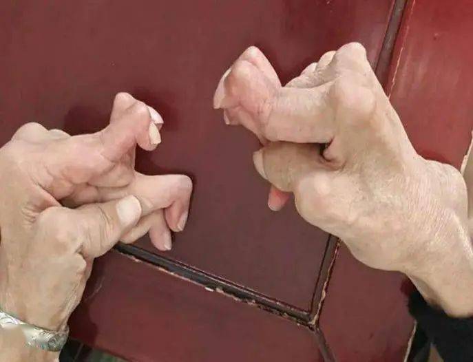 针药结合治尪痹