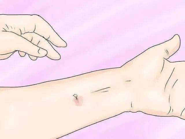 急救小课堂一常见蛰伤和咬伤