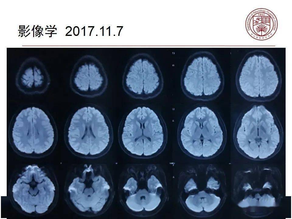 反复发作的脑白质病竟然是._手机搜狐网