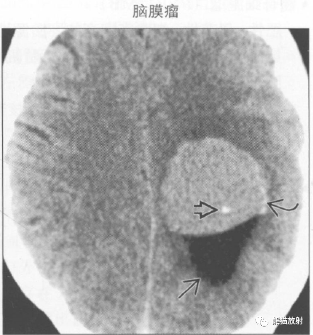 鉴别诊断丨脑室内钙化