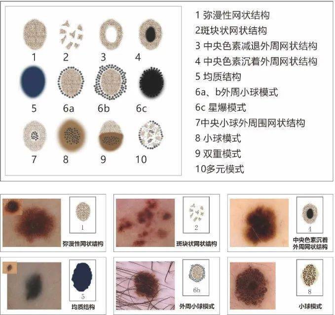 皮肤镜提示蓝白结构图片