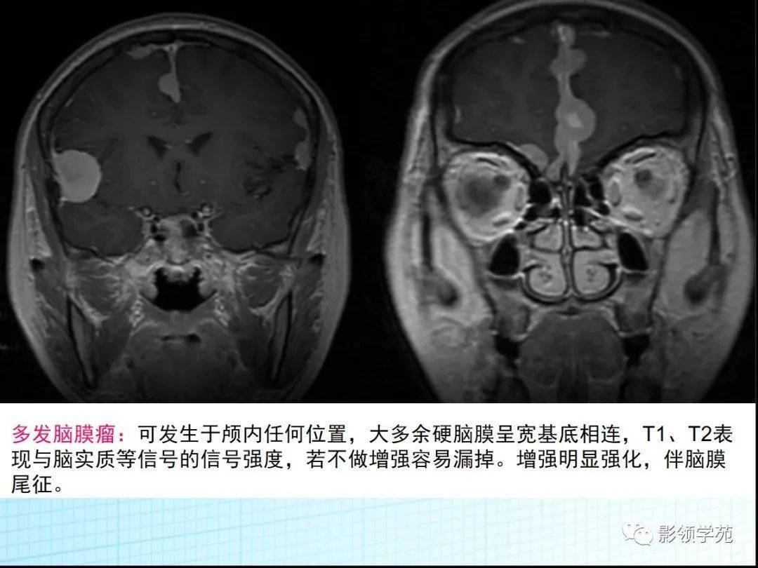 神经纤维瘤病影像表现