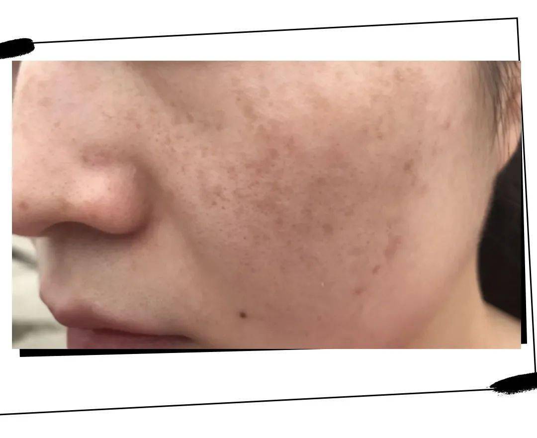 脸发黄,长斑,容易晒黑.