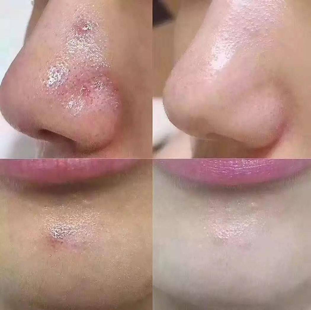 闭口痘痘黑头要管理多久才见效