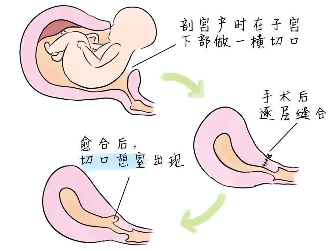 剖宫产手术卡通图片