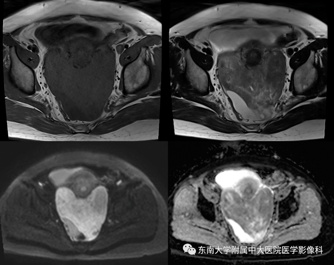 病史 女,50歲,排尿困難1月,加重2天,檢查發現盆腔腫物 mri 平掃 增強