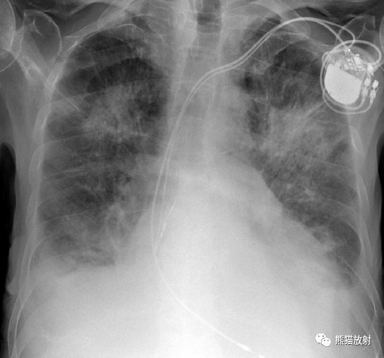 格艾选读丨肺水肿机制x线及ct表现