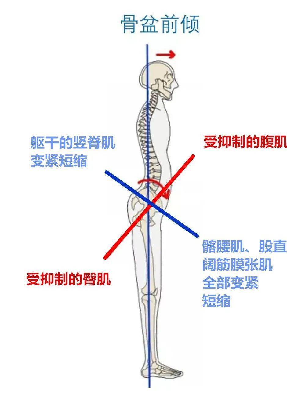 骨盆前倾的4大危害,一个比一个严重!_肌肉