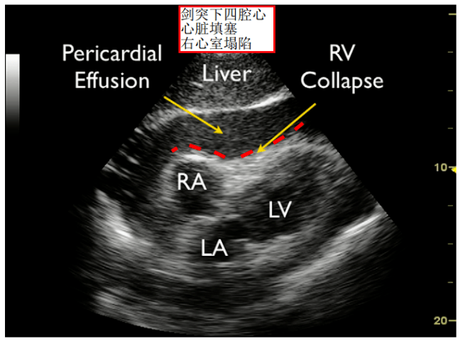 pericardial cavity图片