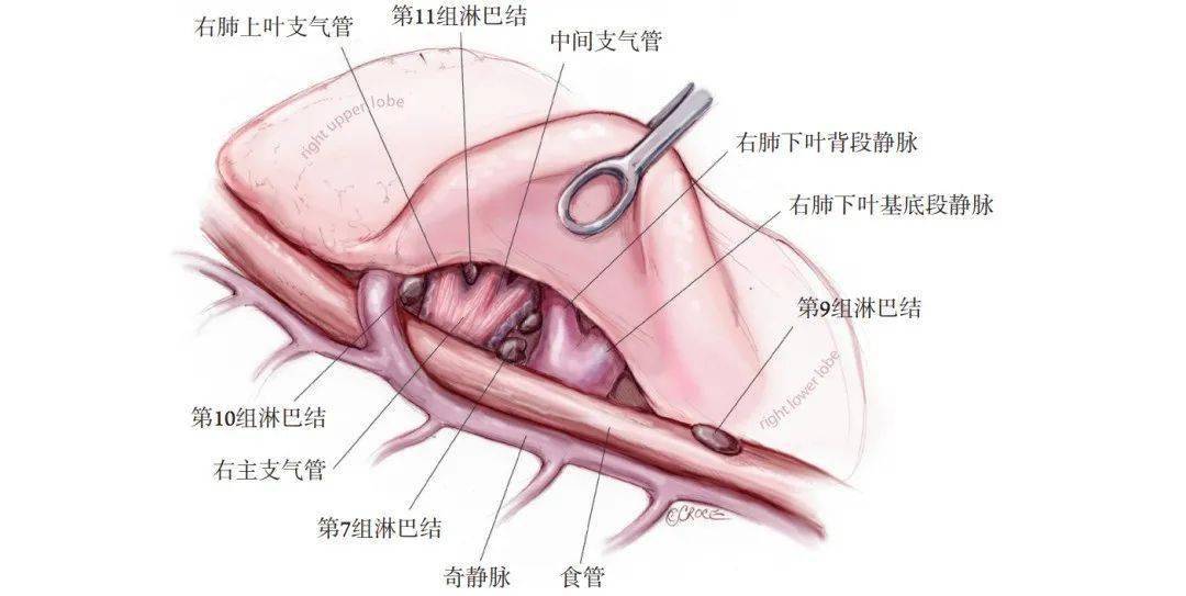 以六大特色探究肺段切除术胸部疾病肺段切除术新书发布在即