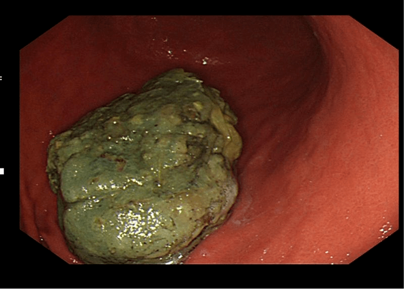 柿子山楂多吃易"惹祸" 胃镜"取石"还有"意外收获"