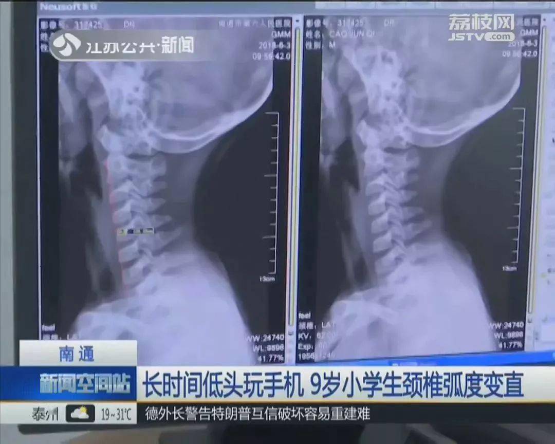9岁小学生颈椎变成一条直线家长发现时已晚了很多孩子都有这习惯