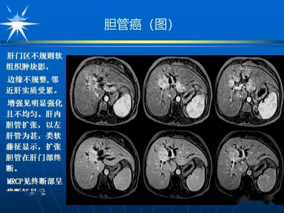 肝门区胆管癌手术后病理结果为胆总管下段腺癌胆总管炎性狭窄