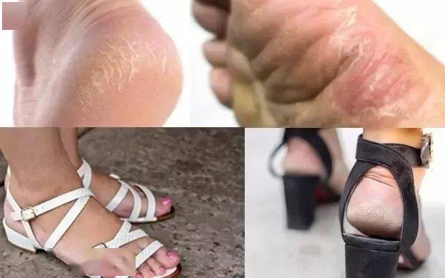 皲裂的现象不注重足部保养的脚还会因为干燥还给脚丫子磨出了厚厚的