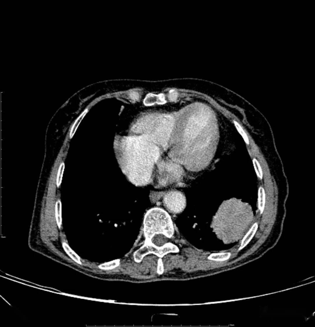 胸部ct平扫示左下肺占位——肺癌
