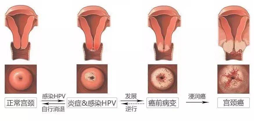 宫颈病变得到治疗后,需要定期宫颈癌筛查,若筛查过程中发现问题,仍然