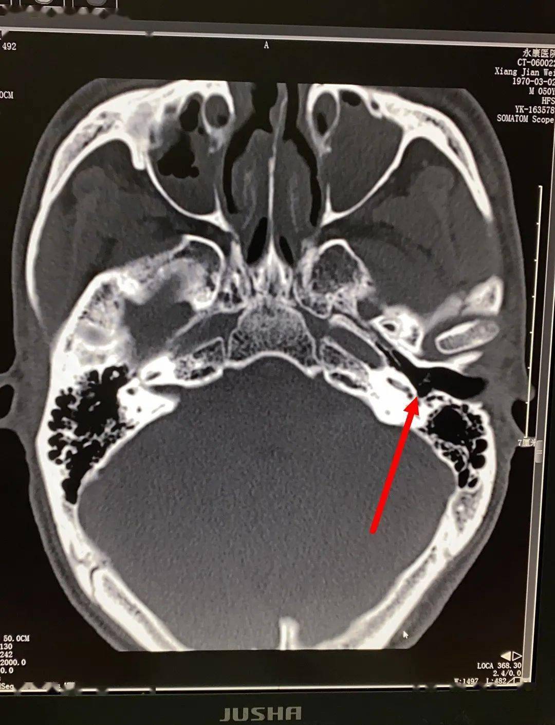 为了确定异物的位置,卢医师让项大叔做了一个颞骨ct检查,可树枝在常规