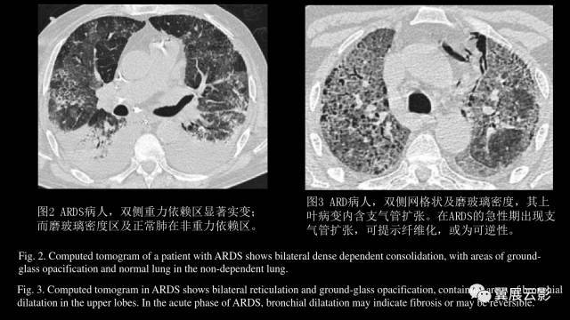 急性呼吸窘迫综合征(ards)的影像学表现