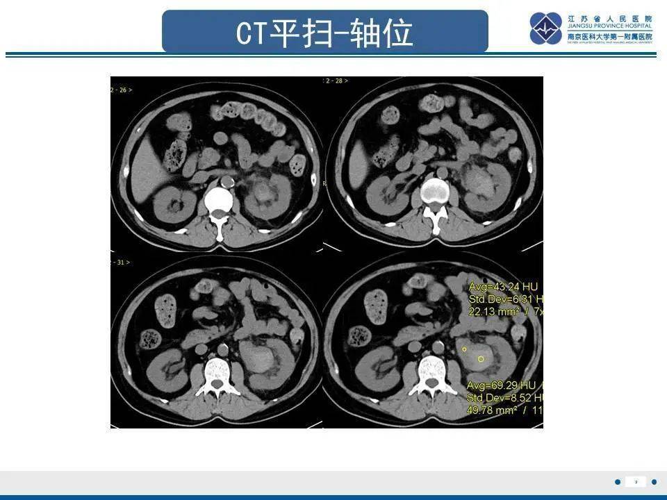 肾盂CT图片