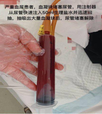 3步轻松解除尿管堵塞资深护士绝招大公开有图