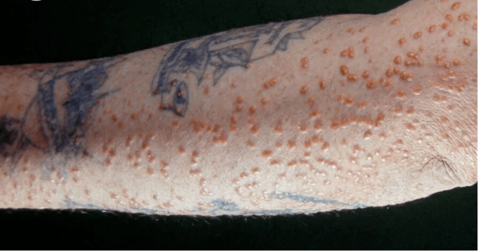 【密集恐惧症慎入】那个与糖尿病有关的皮肤病变_手机搜狐网