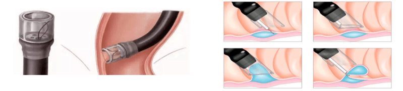 内科微创治疗痔疮没错透明帽辅助内镜下硬化术轻松完成内痔治疗