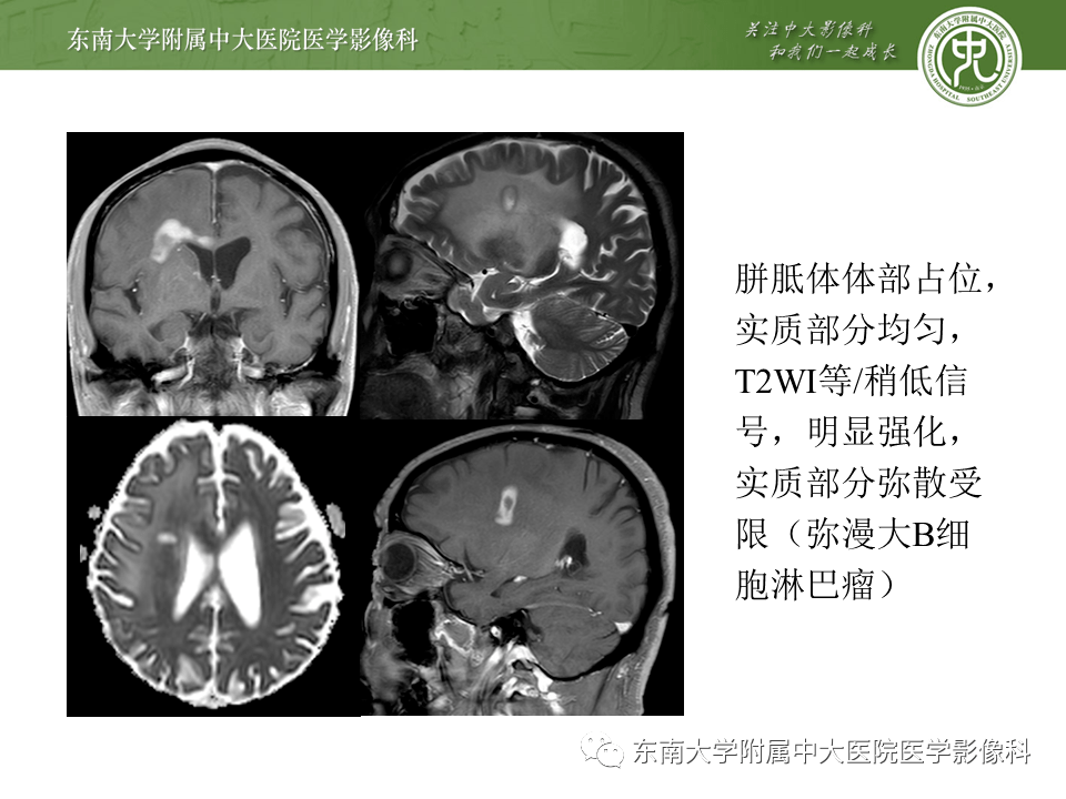 晨读结果公布20201123神经系统疾病可逆性胼胝体压部综合征病例1