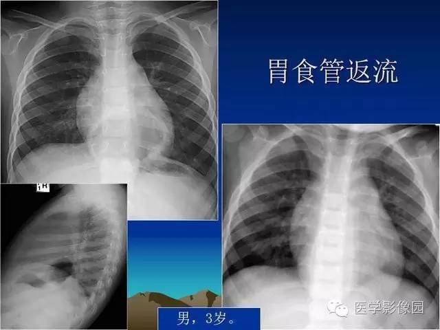常见各类膈疝影像诊断知多少