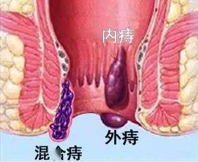 痔疮指人类肛门里,外长的小肉球,是肛周常见疾病,主要分为内痔,外痔