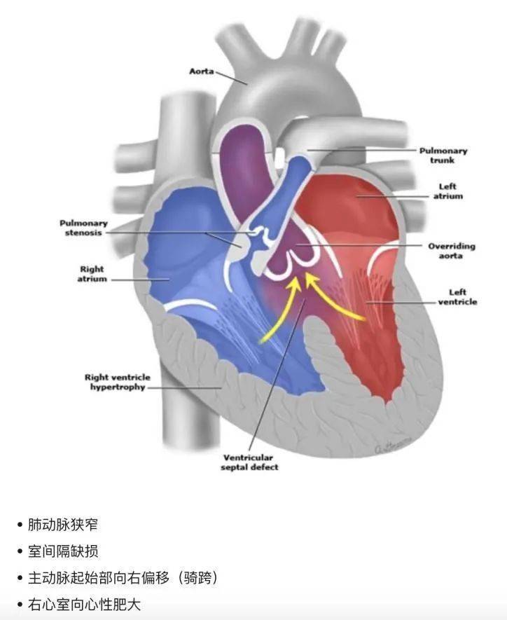 它代表了一种严重的先天性心脏畸形—— 法洛四联症, 小医在心里悄悄