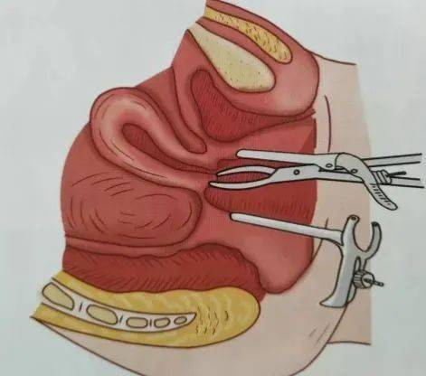 一般腹腔镜手术切除的肌瘤组织通过腹腔镜子宫粉粹器旋切取出,由于