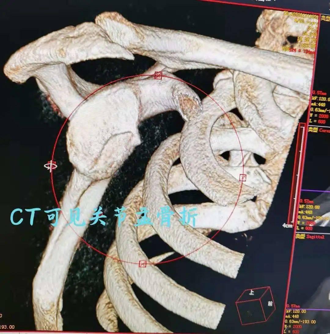 那是因為關節囊撕裂,盂唇軟骨損傷,或者關節盂骨折導致肩關節不穩