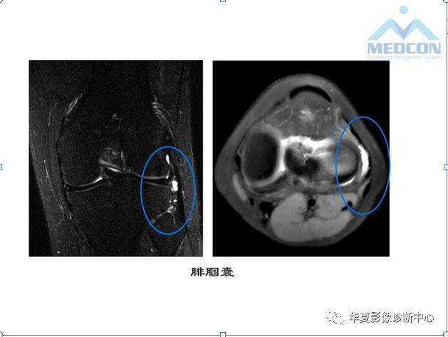 4大关节旁滑囊的精细解剖滑囊病变汇总