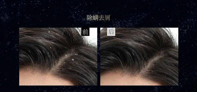 头上抠下的"白泥",居然不是头皮屑?脱发头油都是因为它?_克兰
